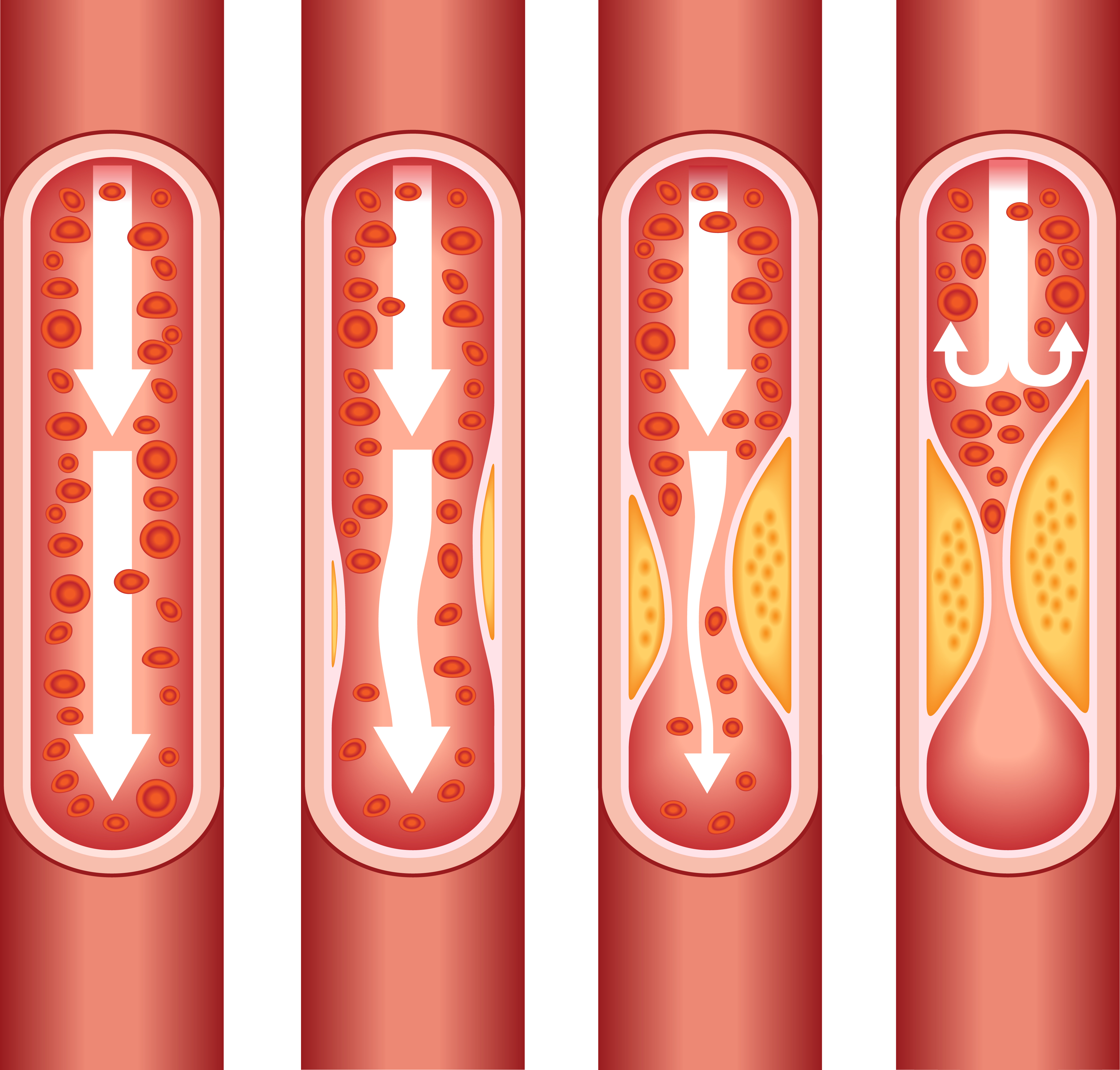 Illustrasjonsbilde av både friske blodårer og blodårer med åreforkalkning.