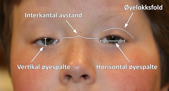 Bilde som viser hvordan symptomer på blefarofimose kan gjenkjennes på øynene. 