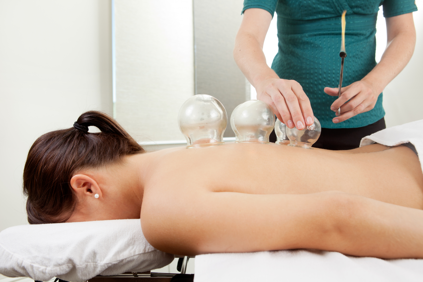 Picture of a woman receiving cupping treatment