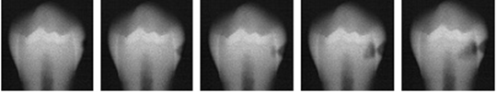 Serie med røntgenbilder som viser hvordan et hull gradvis vokser seg større.