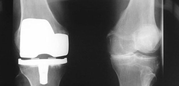 Kneprotese