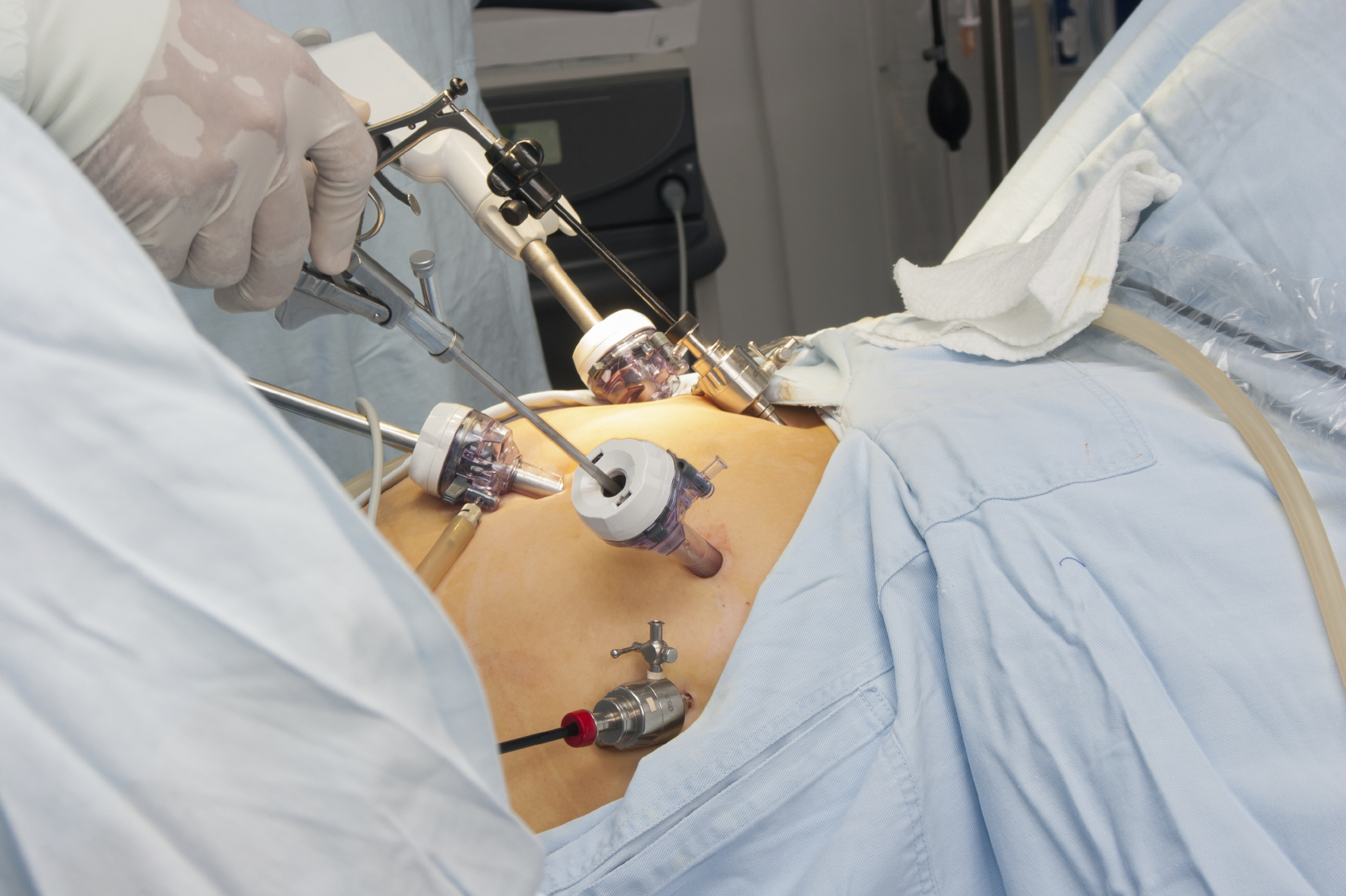 Gastric bypass er en operasjon for å gjøre magen mindre.