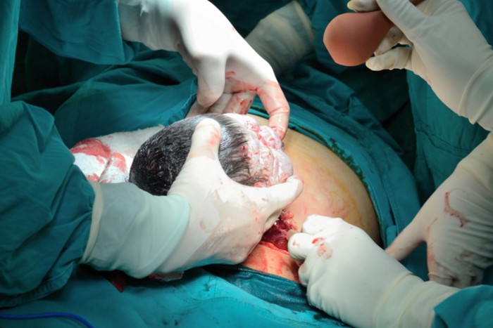 Baby is born by caesarean section.