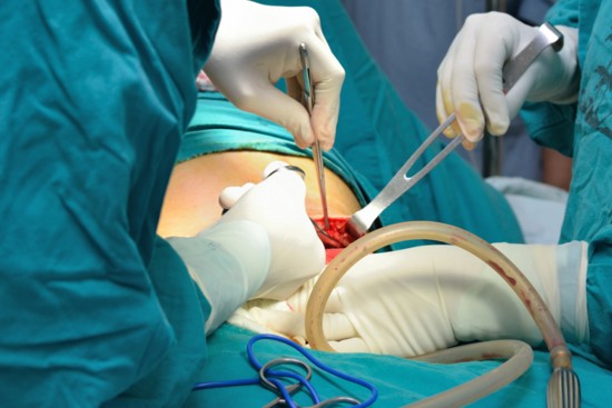 Caesarean section