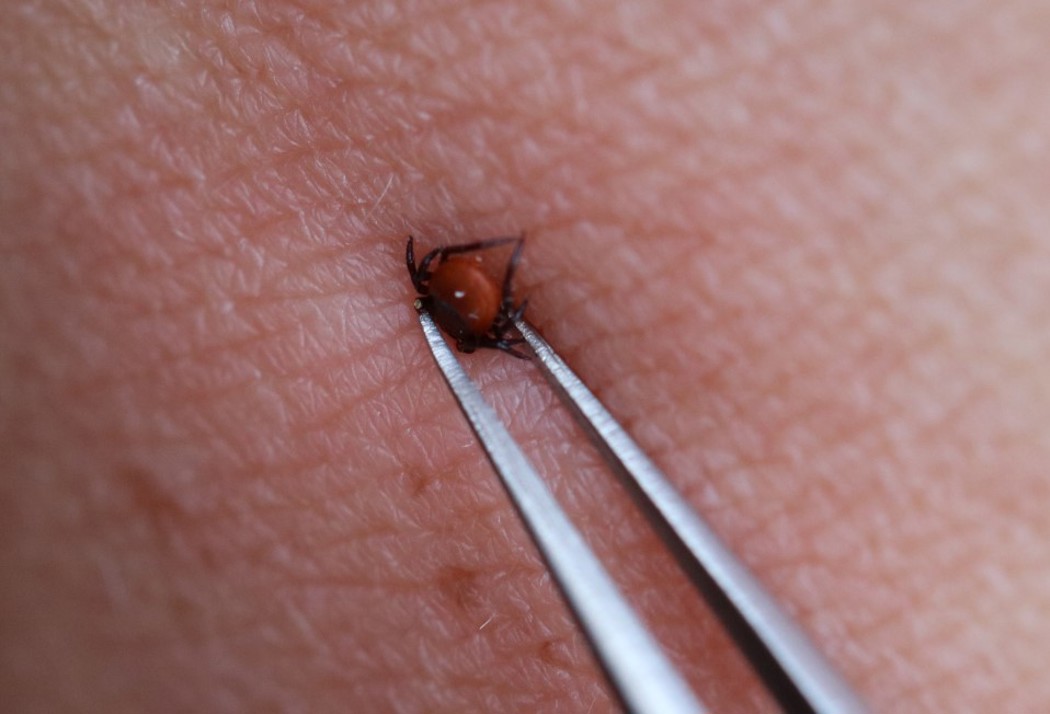 How to remove a tick. Grasp the inside of the skin with tweezers and pull the tick straight out.