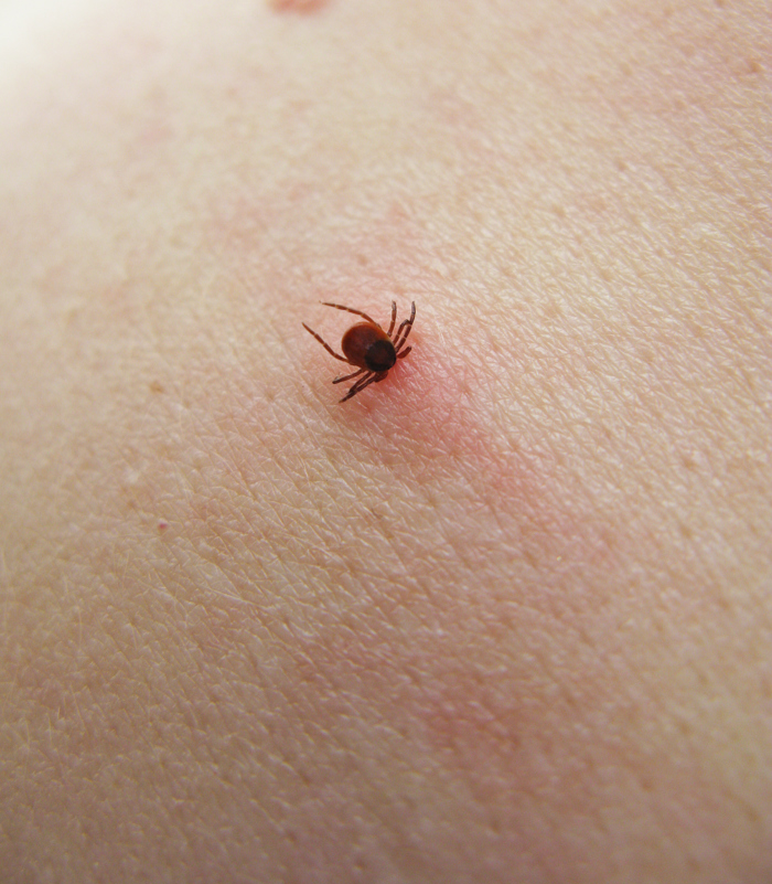 It is important to remove ticks as quickly as possible.