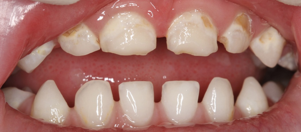 På bildet ses hull i tennene i overkjeven. Hullene er de brune flekkene langs tannkjøttskanten på tennenes overflate