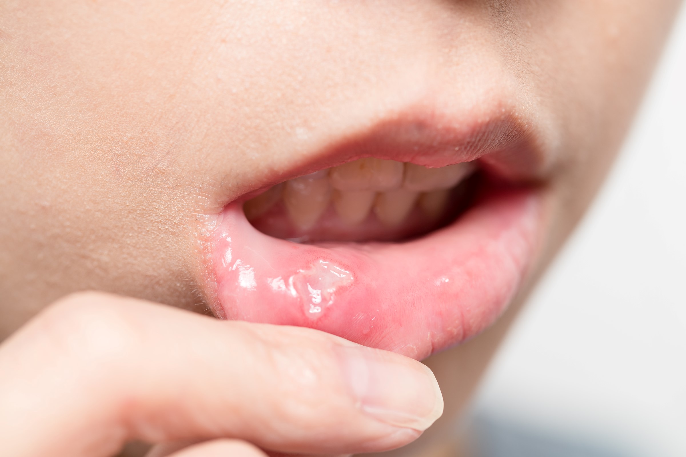 Person med after (munnskold) på innsiden av munnen