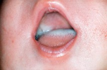 Bilde av spedbarn med trøske på tunga