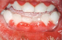 Bildet viser hovent og rødt tannkjøtt på grunn av herpes