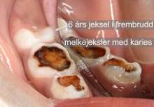 Stort hull i melketann