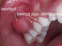 Bilde av tannbyll