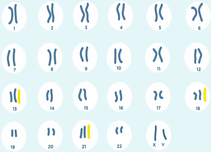 Şekil 2:  Trizomi: Bir ekstra kromozom 13, 18 veya 21