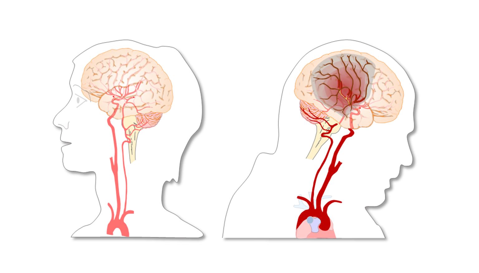 Illustrasjonsbilde av blodpropp ved hjerneslag