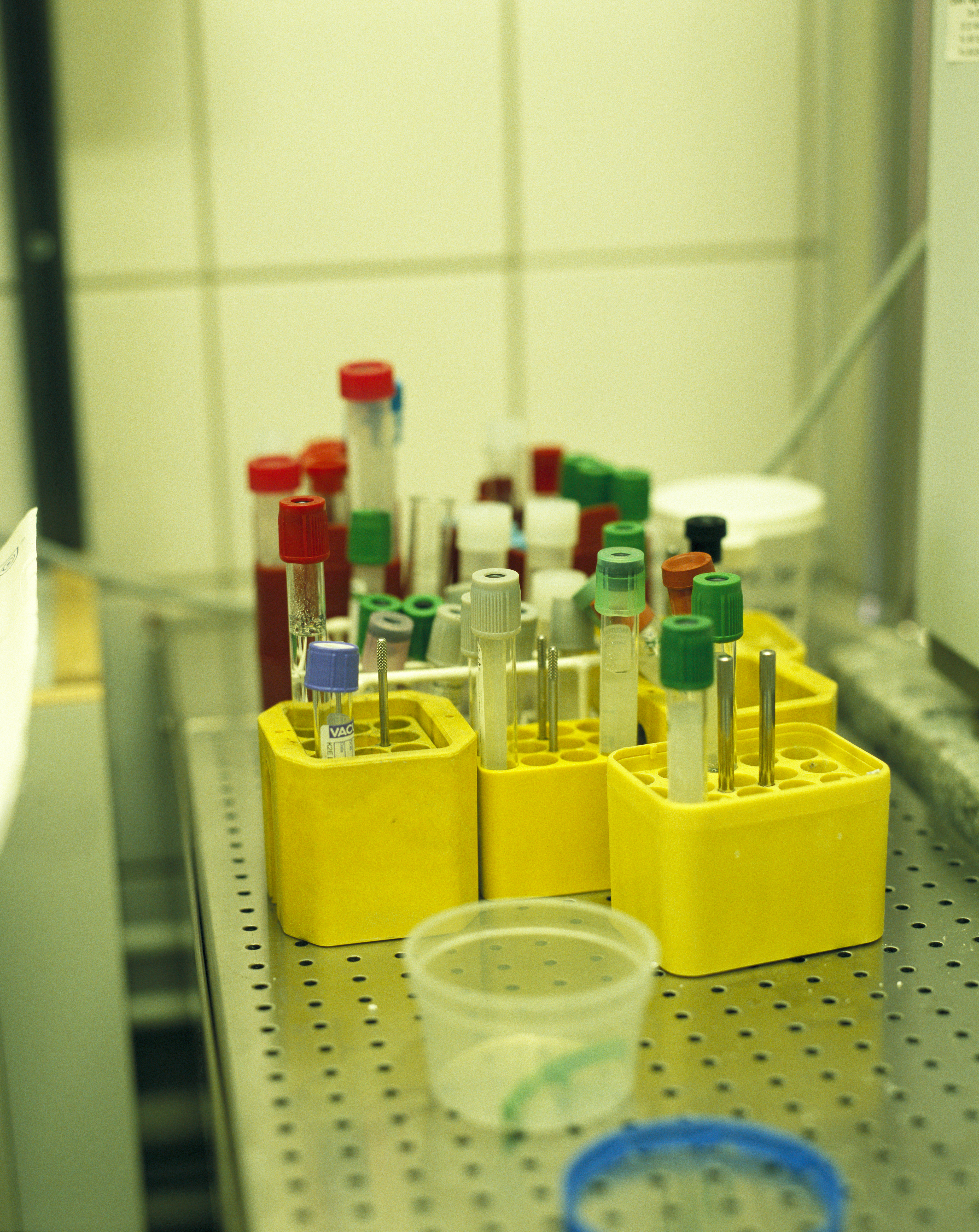When diagnosing HIV blood samples are taken to detect if a person has HIV.